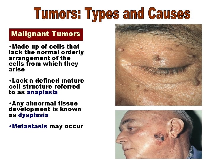 Malignant Tumors • Made up of cells that lack the normal orderly arrangement of