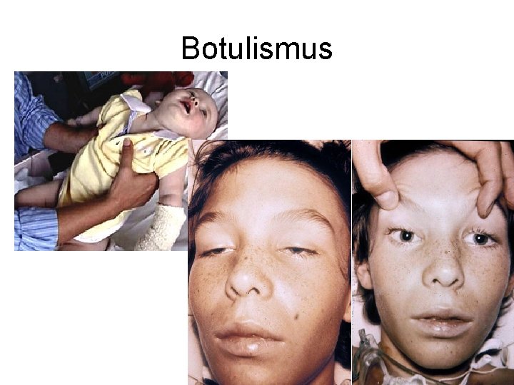 Botulismus 