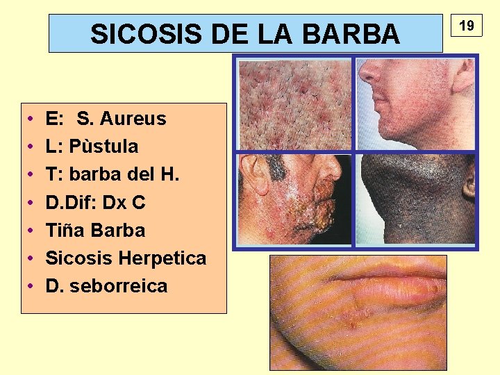 SICOSIS DE LA BARBA • • E: S. Aureus L: Pùstula T: barba del