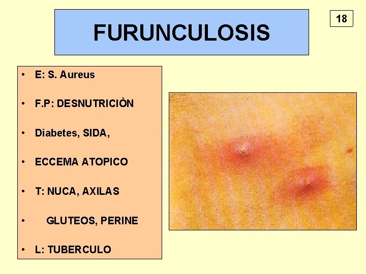 FURUNCULOSIS • E: S. Aureus • F. P: DESNUTRICIÒN • Diabetes, SIDA, • ECCEMA