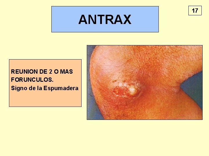 ANTRAX REUNION DE 2 O MAS FORUNCULOS. Signo de la Espumadera 17 