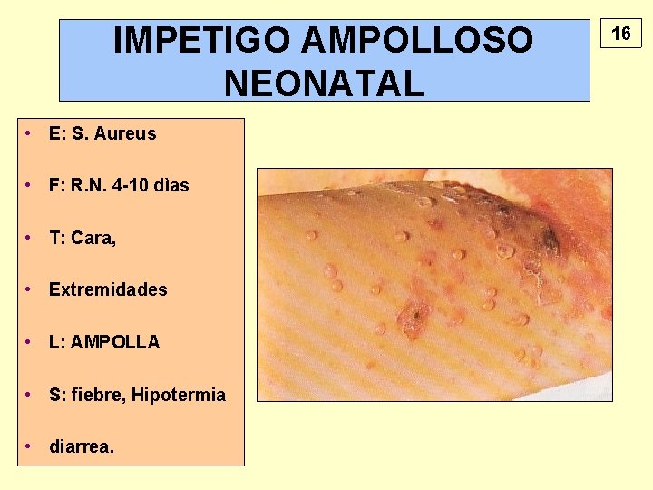 IMPETIGO AMPOLLOSO NEONATAL • E: S. Aureus • F: R. N. 4 -10 dìas