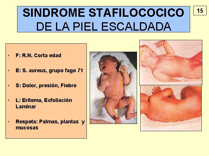 SINDROME STAFILOCOCICO DE LA PIEL ESCALDADA • F: R. N. Corta edad • E: