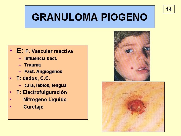 GRANULOMA PIOGENO • E: P. Vascular reactiva – Influencia bact. – Trauma – Fact.