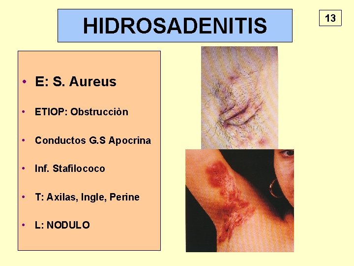 HIDROSADENITIS • E: S. Aureus • ETIOP: Obstrucciòn • Conductos G. S Apocrina •