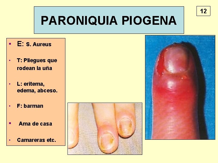 PARONIQUIA PIOGENA • E: S. Aureus • T: Pliegues que rodean la uña •