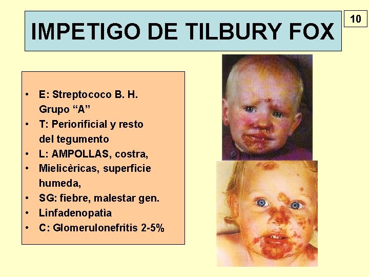 IMPETIGO DE TILBURY FOX • E: Streptococo B. H. Grupo “A” • T: Periorificial