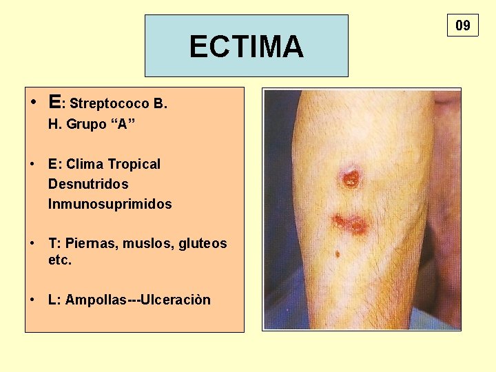 ECTIMA • E: Streptococo B. H. Grupo “A” • E: Clima Tropical Desnutridos Inmunosuprimidos