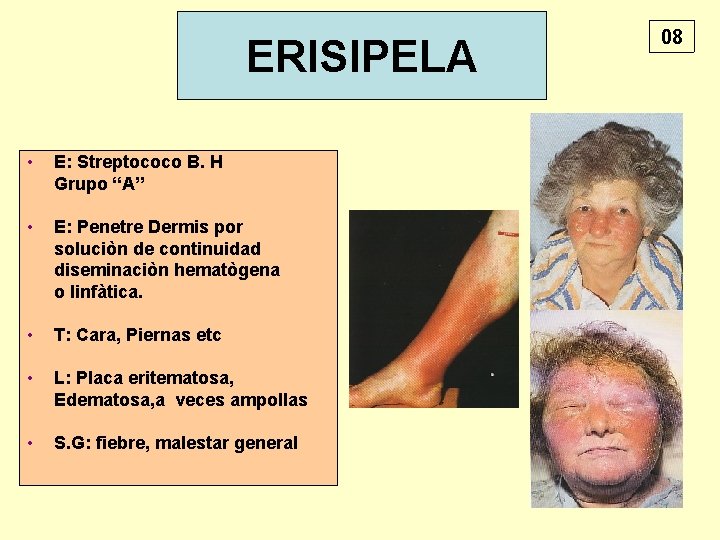 ERISIPELA • E: Streptococo B. H Grupo “A” • E: Penetre Dermis por soluciòn