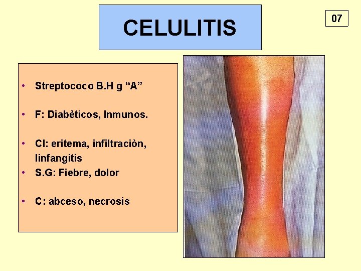 CELULITIS • Streptococo B. H g “A” • F: Diabèticos, Inmunos. • Cl: eritema,