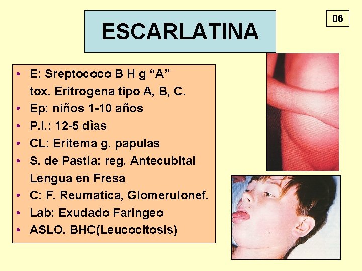 ESCARLATINA • E: Sreptococo B H g “A” tox. Eritrogena tipo A, B, C.