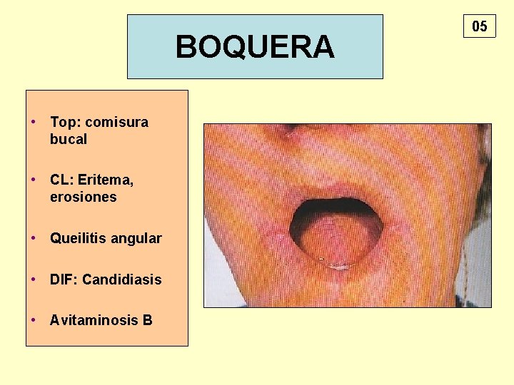 BOQUERA • Top: comisura bucal • CL: Eritema, erosiones • Queilitis angular • DIF: