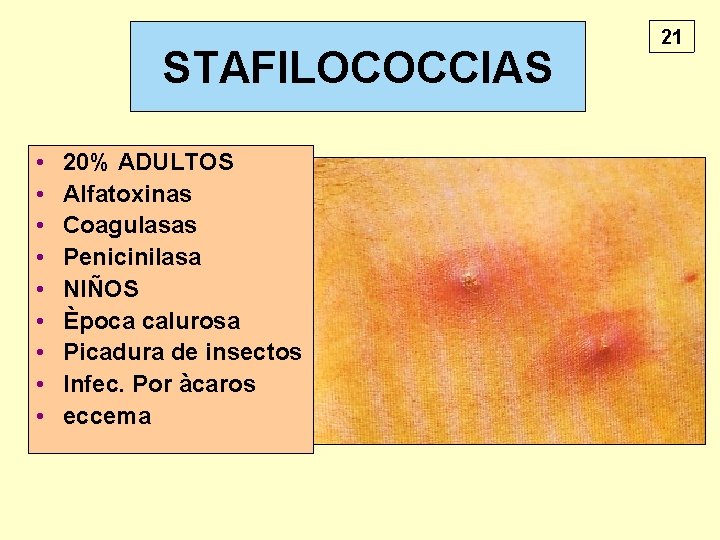 STAFILOCOCCIAS • • • 20% ADULTOS Alfatoxinas Coagulasas Penicinilasa NIÑOS Època calurosa Picadura de