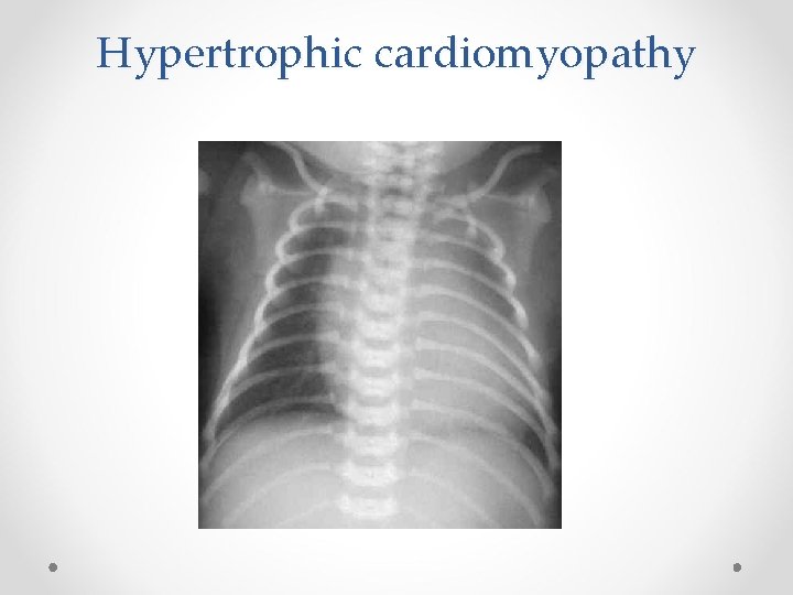 Hypertrophic cardiomyopathy 