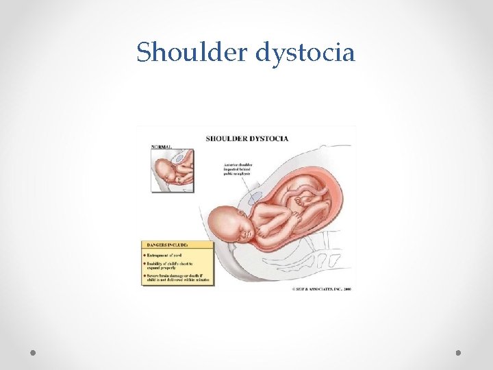 Shoulder dystocia 