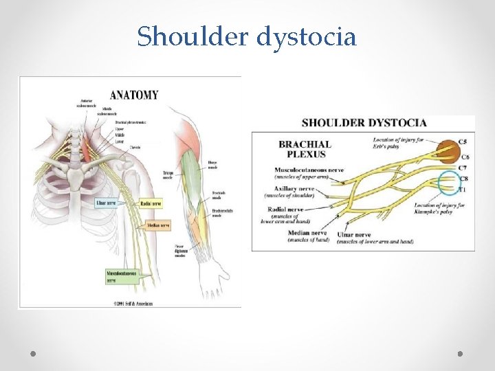 Shoulder dystocia 