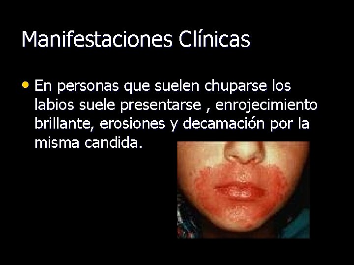 Manifestaciones Clínicas • En personas que suelen chuparse los labios suele presentarse , enrojecimiento