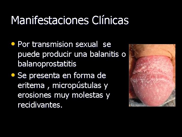 Manifestaciones Clínicas • Por transmision sexual se puede producir una balanitis o balanoprostatitis •