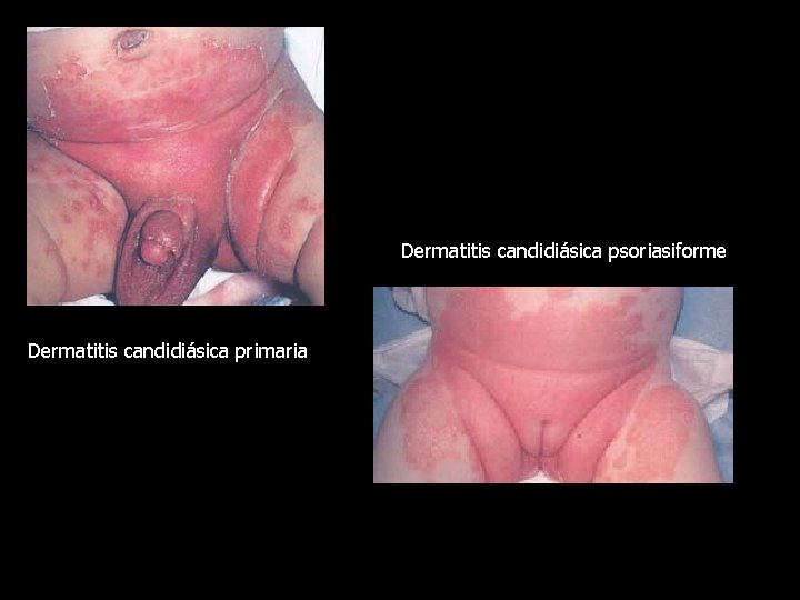 Dermatitis candidiásica psoriasiforme Dermatitis candidiásica primaria 