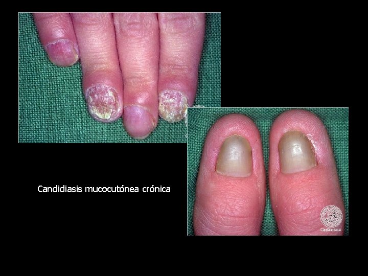 Candidiasis mucocutónea crónica 