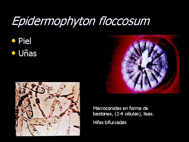 Epidermophyton floccosum • Piel • Uñas Macroconidas en forma de bastones, (2 -4 células),