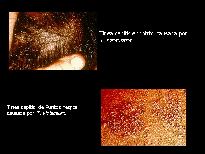 Tinea capitis endotrix causada por T. tonsurans Tinea capitis de Puntos negros causada por