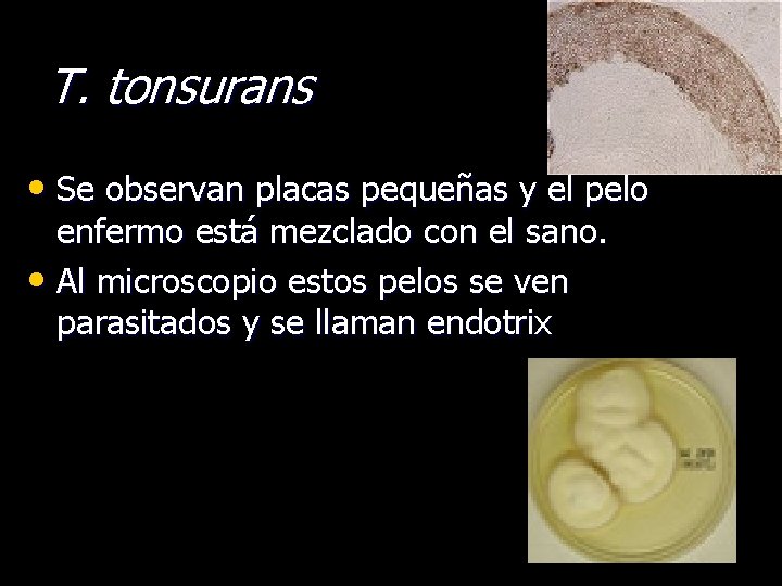 T. tonsurans • Se observan placas pequeñas y el pelo enfermo está mezclado con