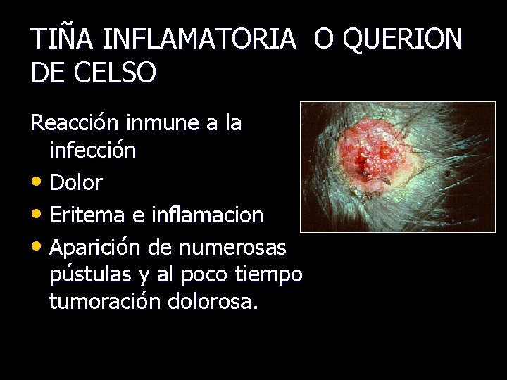 TIÑA INFLAMATORIA O QUERION DE CELSO Reacción inmune a la infección • Dolor •