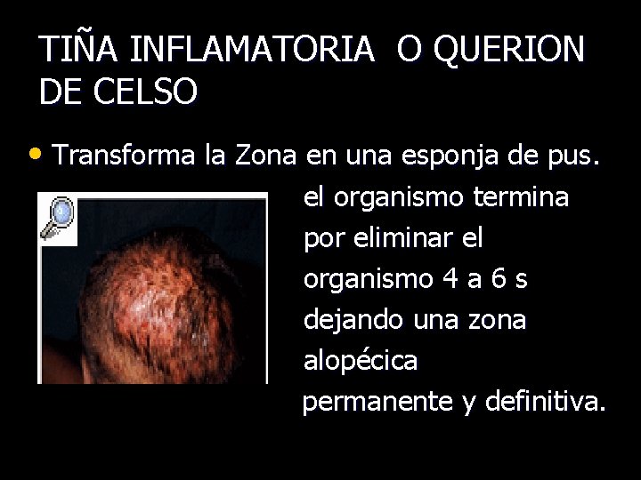 TIÑA INFLAMATORIA O QUERION DE CELSO • Transforma la Zona en una esponja de