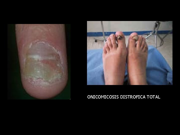 ONICOMICOSIS DISTROFICA TOTAL 