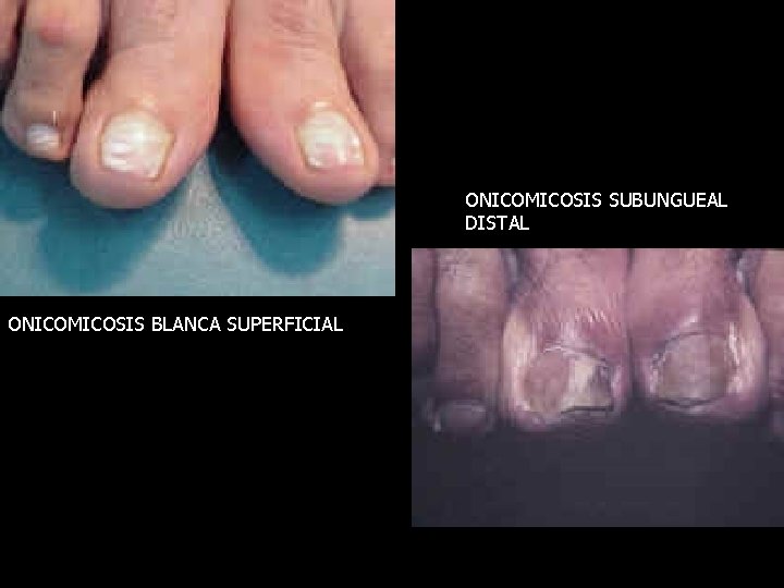 ONICOMICOSIS SUBUNGUEAL DISTAL ONICOMICOSIS BLANCA SUPERFICIAL 