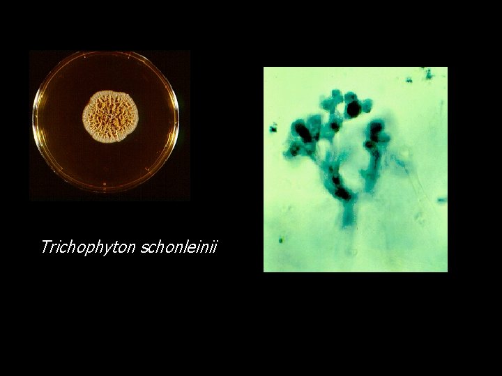 Trichophyton schonleinii 