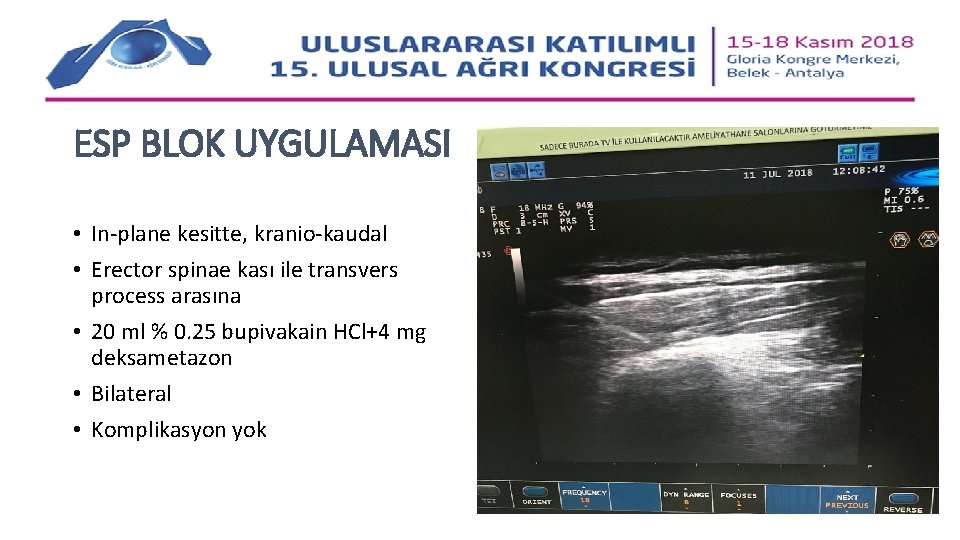 ESP BLOK UYGULAMASI • In-plane kesitte, kranio-kaudal • Erector spinae kası ile transvers process