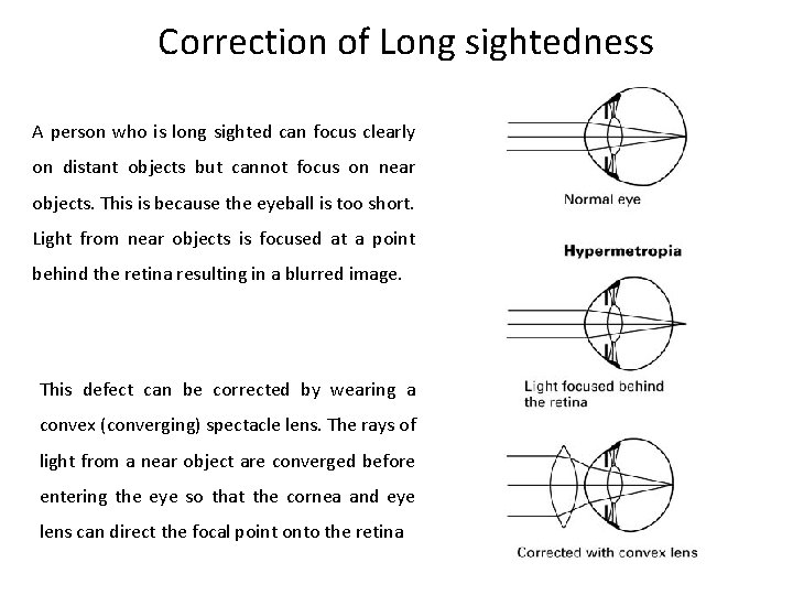 Correction of Long sightedness A person who is long sighted can focus clearly on
