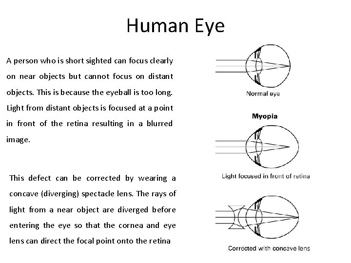 Human Eye A person who is short sighted can focus clearly on near objects