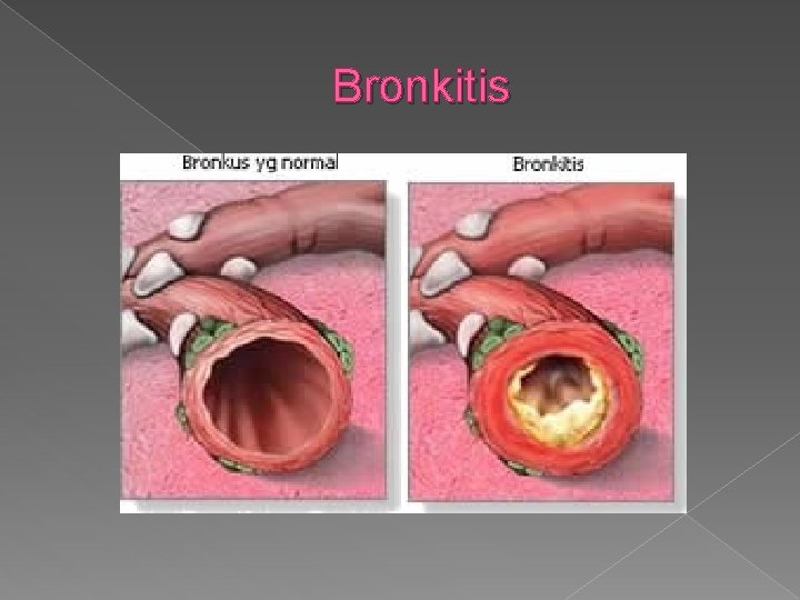 Bronkitis 