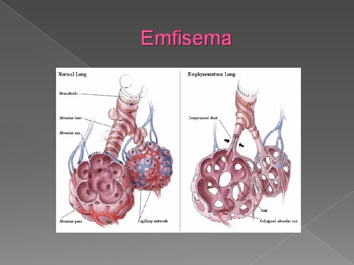 Emfisema 