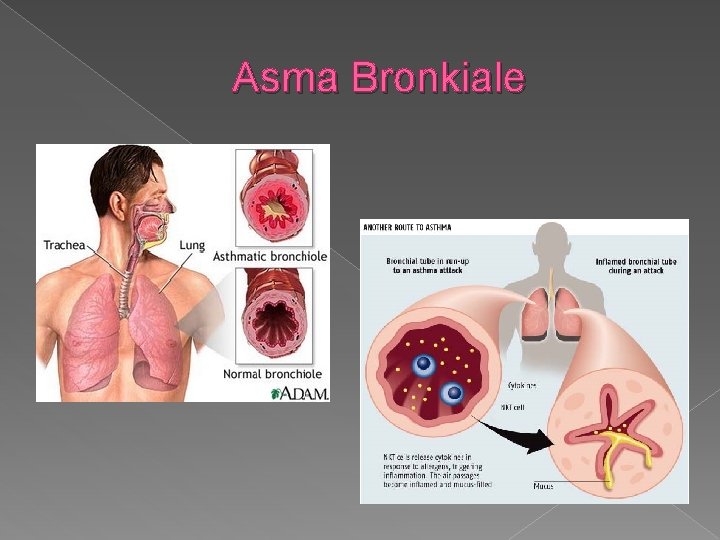 Asma Bronkiale 