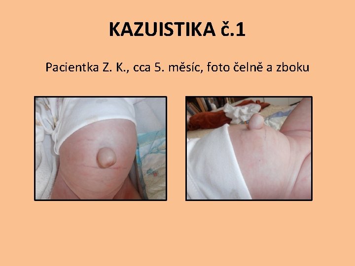 KAZUISTIKA č. 1 Pacientka Z. K. , cca 5. měsíc, foto čelně a zboku