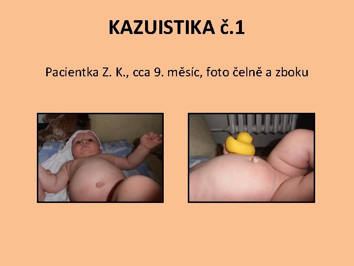 KAZUISTIKA č. 1 Pacientka Z. K. , cca 9. měsíc, foto čelně a zboku