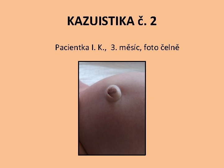 KAZUISTIKA č. 2 Pacientka I. K. , 3. měsíc, foto čelně 