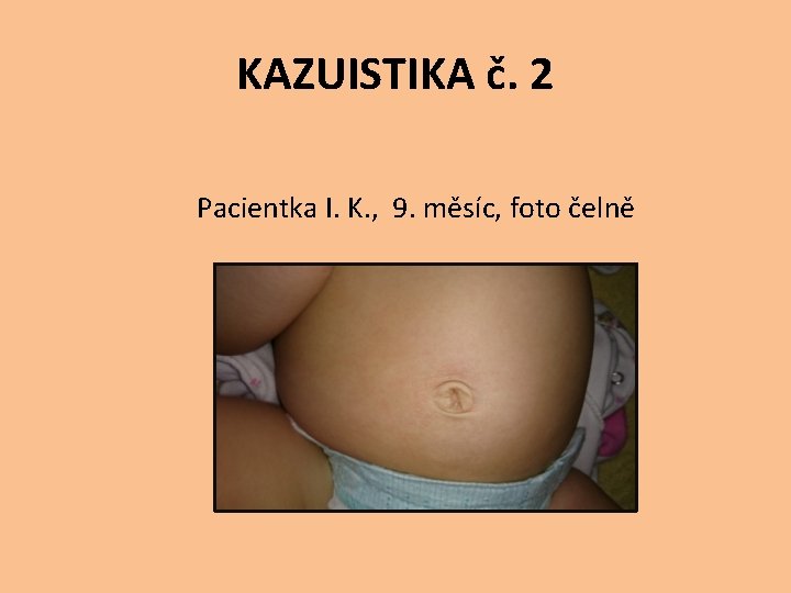 KAZUISTIKA č. 2 Pacientka I. K. , 9. měsíc, foto čelně 