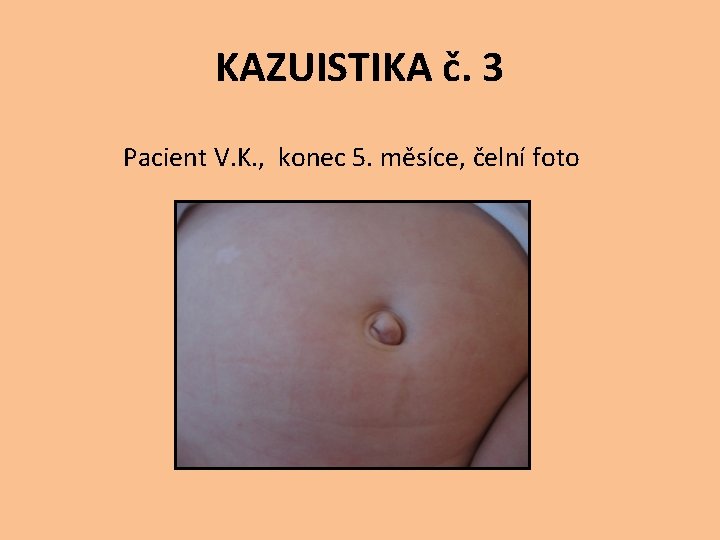 KAZUISTIKA č. 3 Pacient V. K. , konec 5. měsíce, čelní foto 