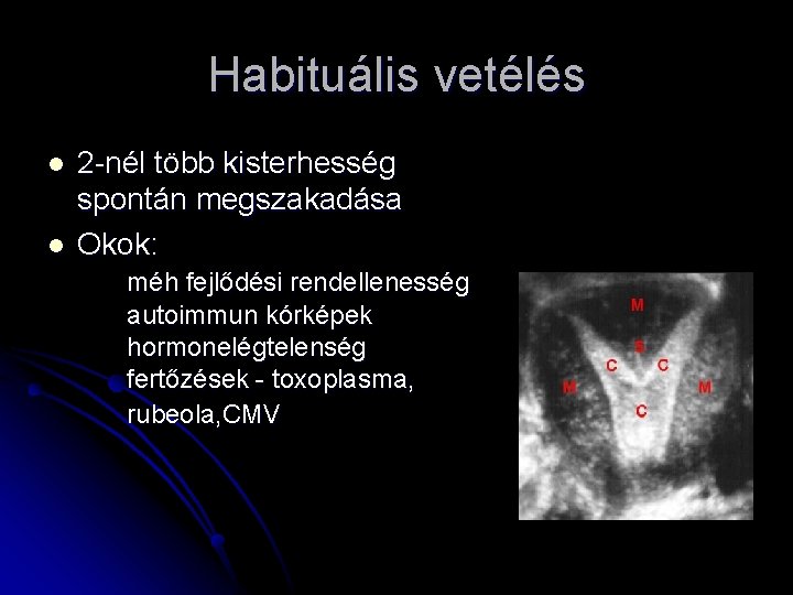 Habituális vetélés l l 2 -nél több kisterhesség spontán megszakadása Okok: méh fejlődési rendellenesség