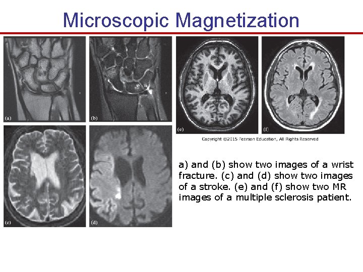 Microscopic Magnetization a) and (b) show two images of a wrist fracture. (c) and