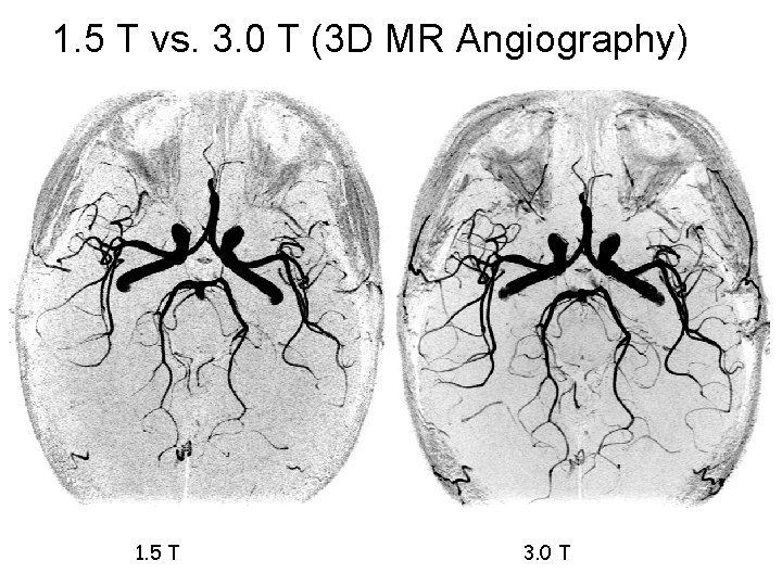 1. 5 T vs. 3. 0 T (3 D MR Angiography) 1. 5 T