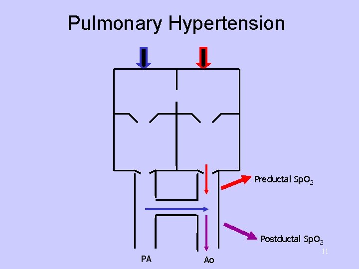 Pulmonary Hypertension Preductal Sp. O 2 Postductal Sp. O 2 PA Ao 11 