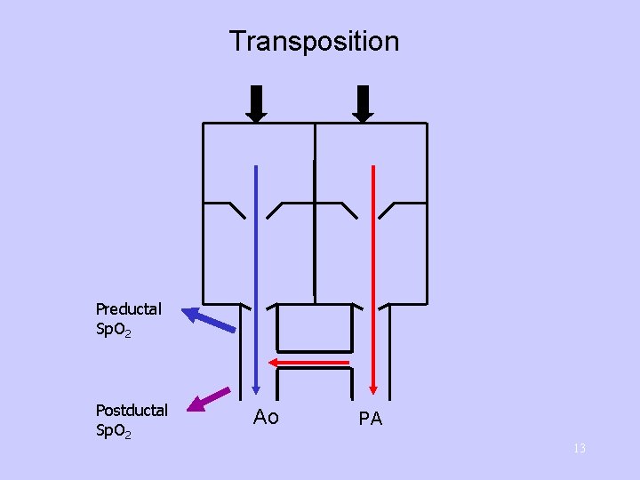 Transposition Preductal Sp. O 2 Postductal Sp. O 2 Ao PA 13 