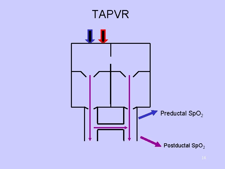 TAPVR Preductal Sp. O 2 Postductal Sp. O 2 14 