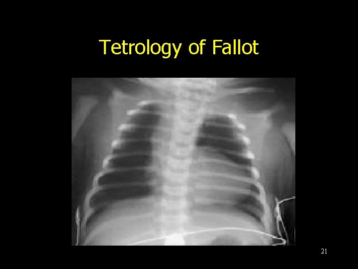 Tetrology of Fallot 21 